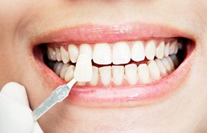 در رابطه با لمینت دندان چه می دانید؟