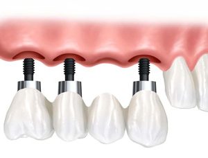 در رابطه با ایمپلنت دندان هایتان چه می دانید؟