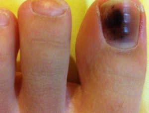 دلایل و درمان سیاه شدن ناخن پا چیست؟